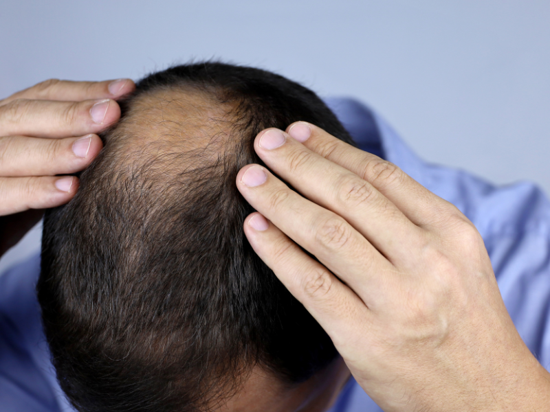 Hair Loss in Men