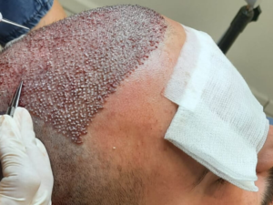 Hair Transplant Clinic Delhi