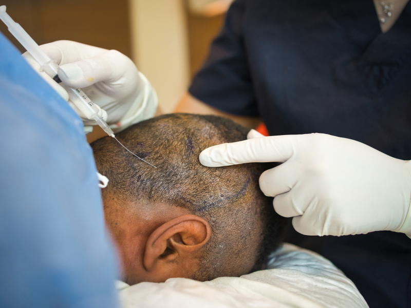Hair Transplant in Delhi