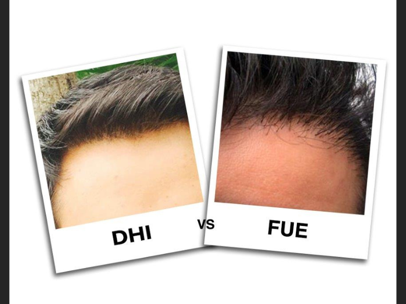 FUE vs DHI hair transplant techniques comparison