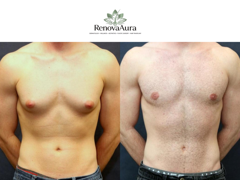 Gynecomastia Surgery in delhi