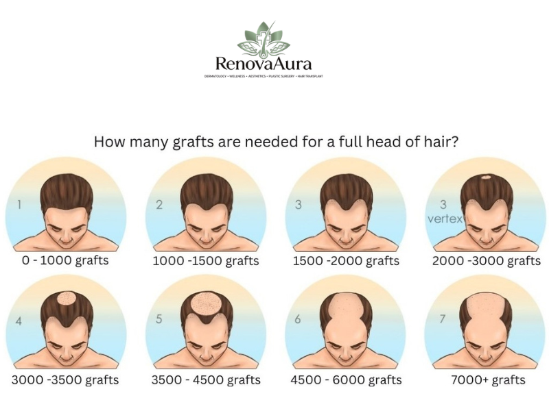 How Many Grafts Do You Need for a Hair Transplant? A Doctor’s Guide