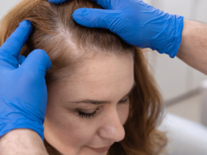 Woman considering hair transplant for female hair loss