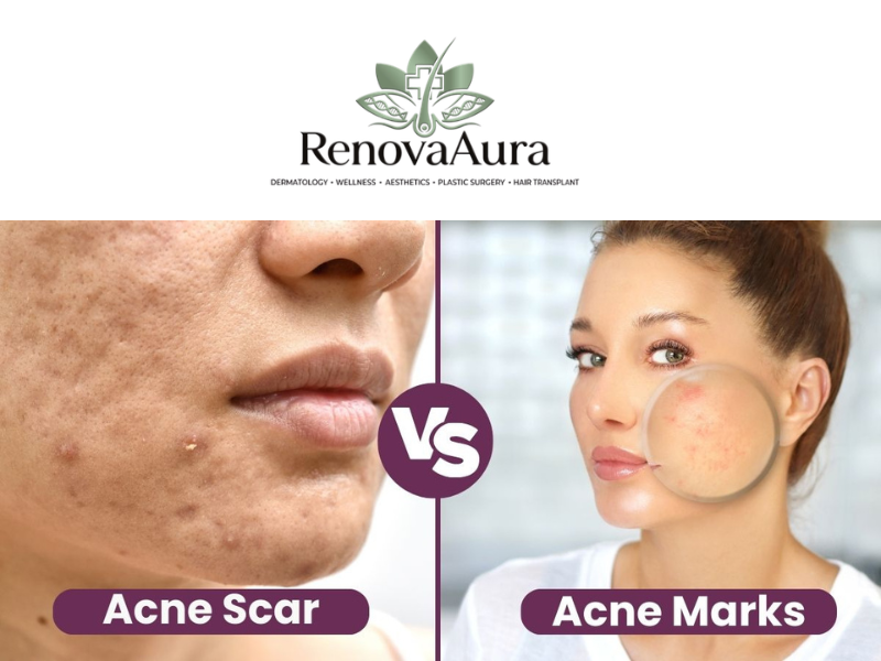 Comparison of acne scars and acne marks on facial skin